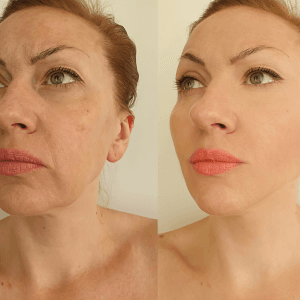 Schönheitspraxis Dr. Dado - Fraxel Dual Laser Zentrum